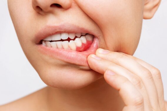 Dental Clinics - Bloedend tandvlees – Dental Clinics-min