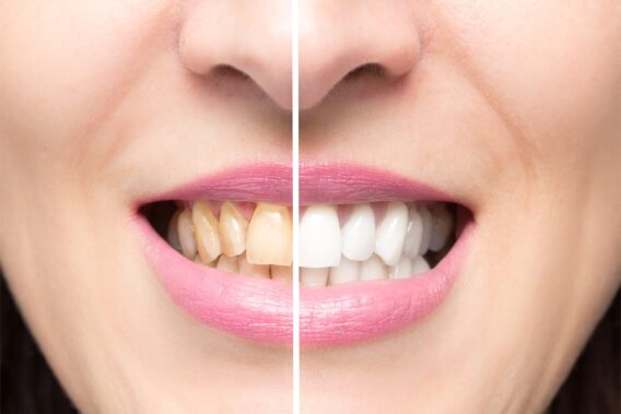 Roken & mondgezondheid: Gele tanden - Dental Clinics