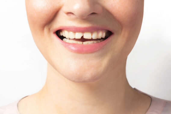 Dental Clinics - Afgebroken tand – Dental Clinics