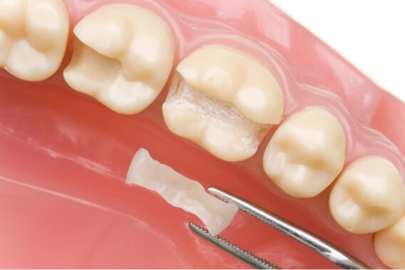 Inlays - Dental Clinics
