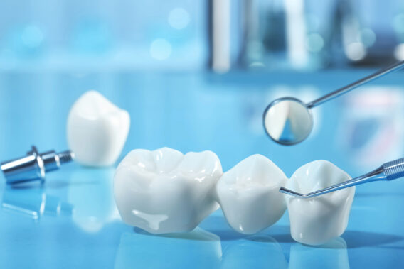 Dental Clinics - Kronen, inlays & bruggen – Dental Clinics