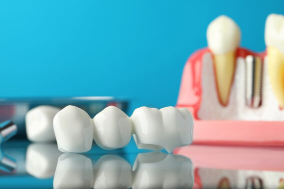 Dental Clinics - Kronen inlays en bruggen – Dental Clinics