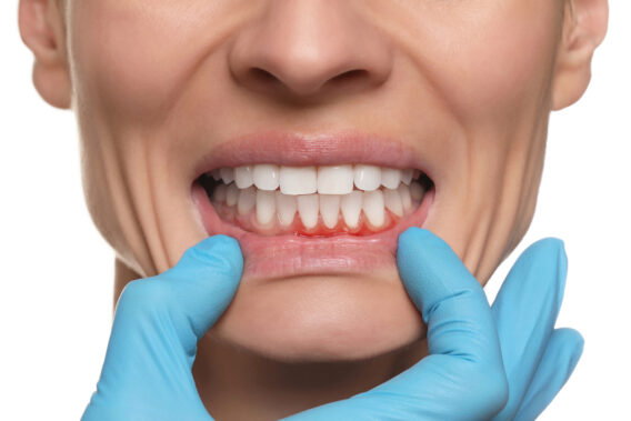 Dental Clinics - Ontstoken tandvlees – Dental Clinics