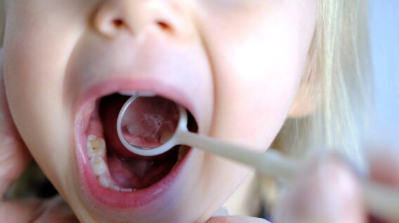 Dental Clinics - Kaaskiezen kinderen